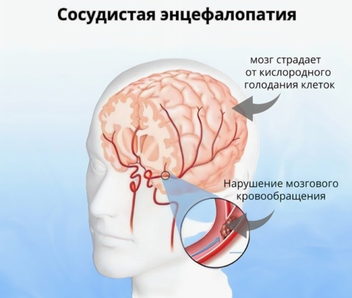 Эпилепсия и Энцефалопатия - какой камень может помочь.. |БЕЛЫЙ СВЕТ1